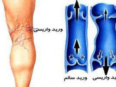 روش صحیح درمان واریس با گوجه فرنگی