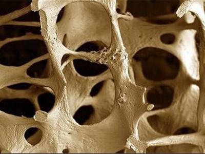 ۱۵ دستورالعمل ساده برای درمان پوکی استخوان کنید!