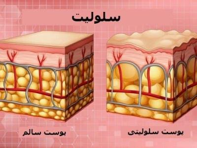 سلولیت چیست و چگونه می توان آن را درمان کرد؟