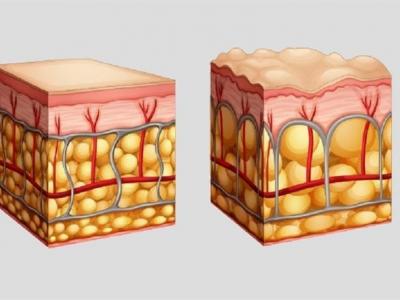 دلایل و درمان سلولیت؛ چگونه سلولیت را از بین ببریم؟